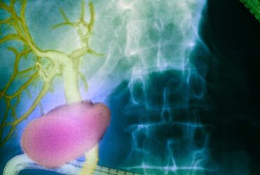 p5300171 gall bladder and bile ducts x ray 800x533 1 1